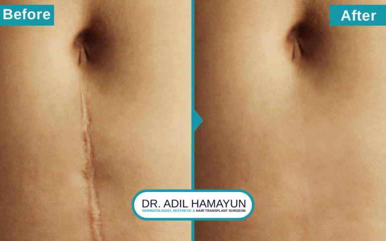 Best Doctor For Post Surgical Marks and Scars Removal in Peshawar