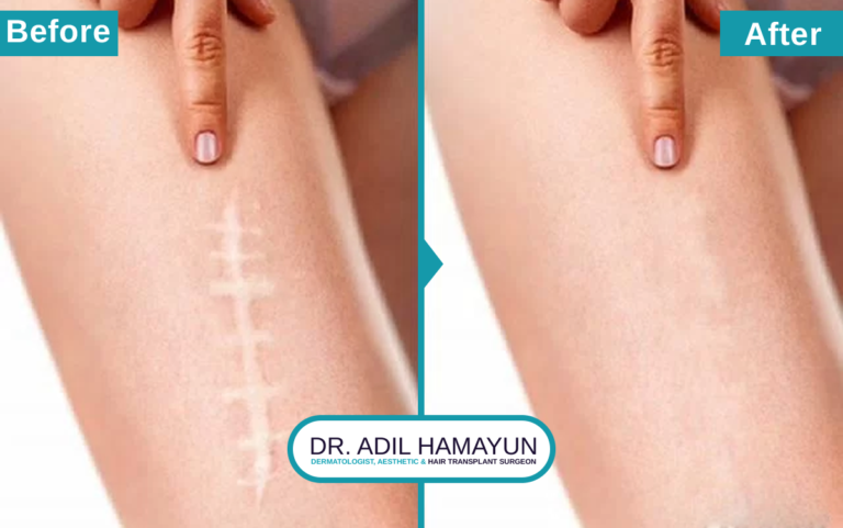 Best Doctor For Post Surgical Marks and Scars Removal in Peshawar