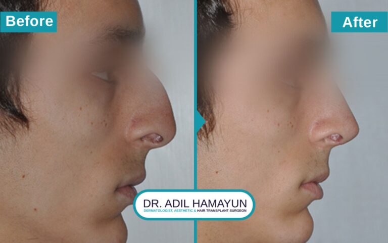 Surgical Rhinoplasty