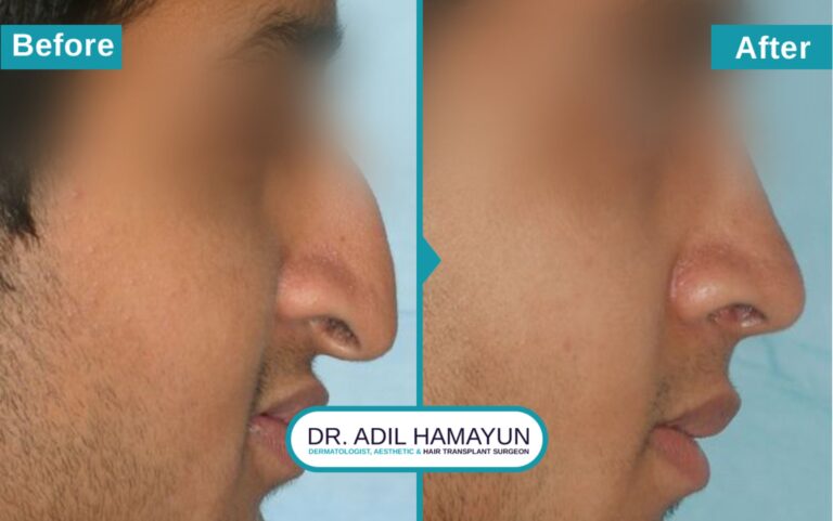 Surgical Rhinoplasty