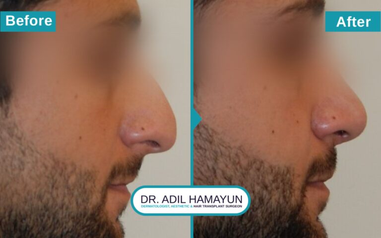 Surgical Rhinoplasty