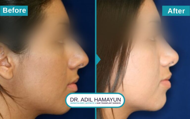 Surgical Rhinoplasty