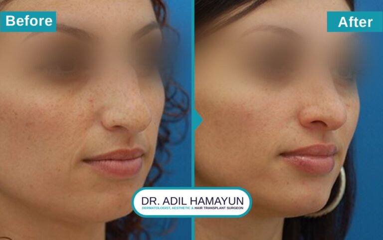 Surgical Rhinoplasty