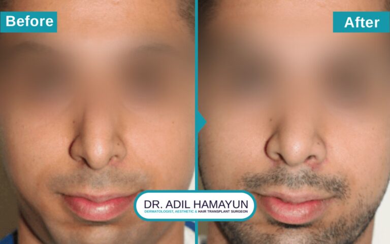 Surgical Rhinoplasty