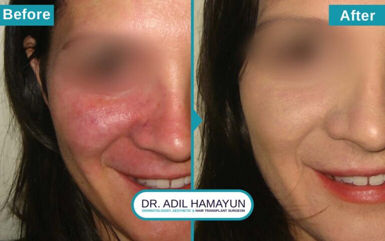 Rosacea Treatment