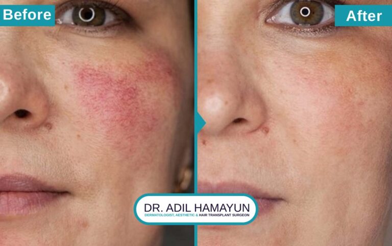 Rosacea Treatment