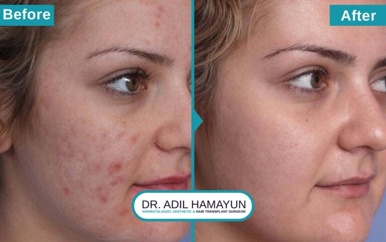 Acne Removal Treatment