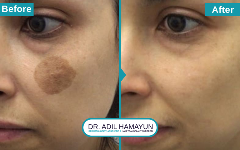 Birthmark Removal Treatment in Peshawar