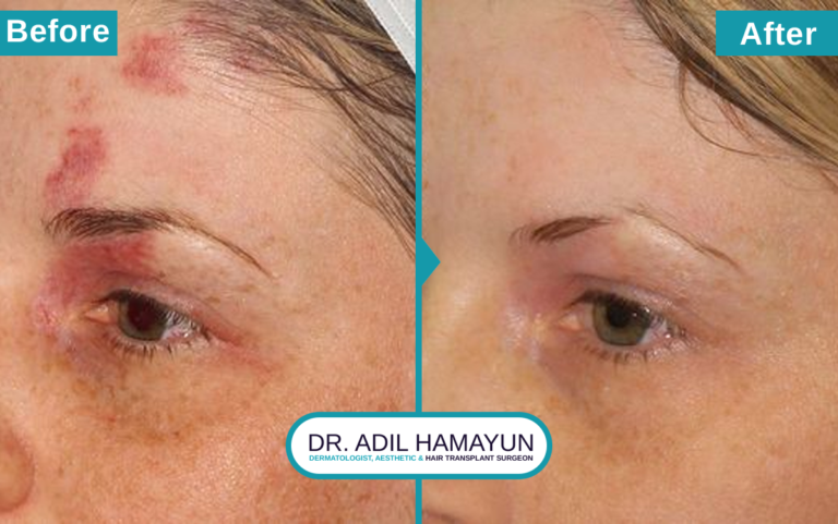 Birthmark Removal Treatment in Peshawar