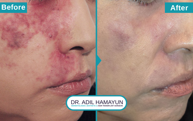 Birthmark Removal Treatment in Peshawar