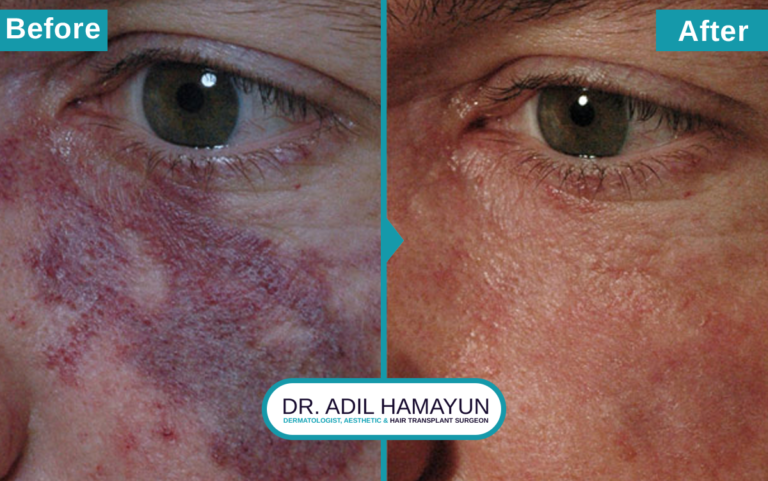 Birthmark Removal Treatment in Peshawar