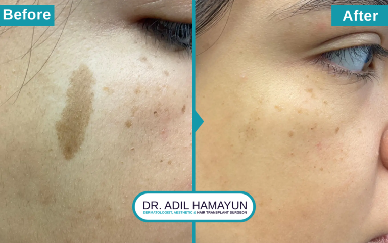 Birthmark Removal Treatment in Peshawar