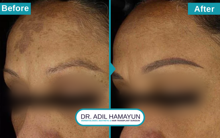 Birthmark Removal Treatment in Peshawar