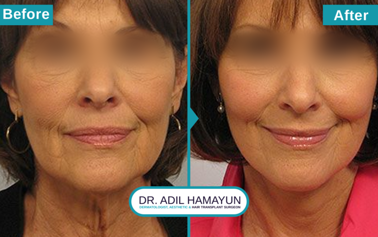 Best Facelift Treatment in Peshawar