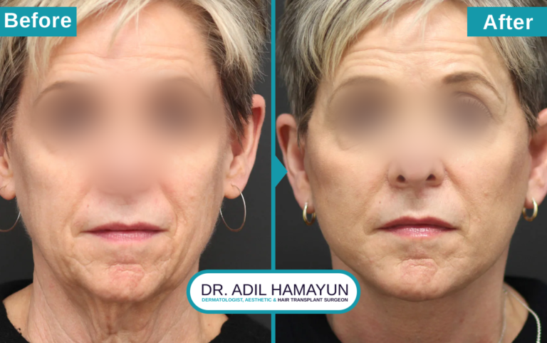 Best Facelift Treatment in Peshawar