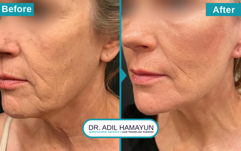 Best Facelift Treatment in Peshawar