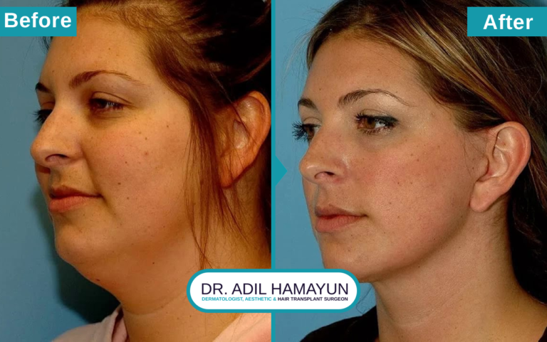 Best Facelift Treatment in Peshawar