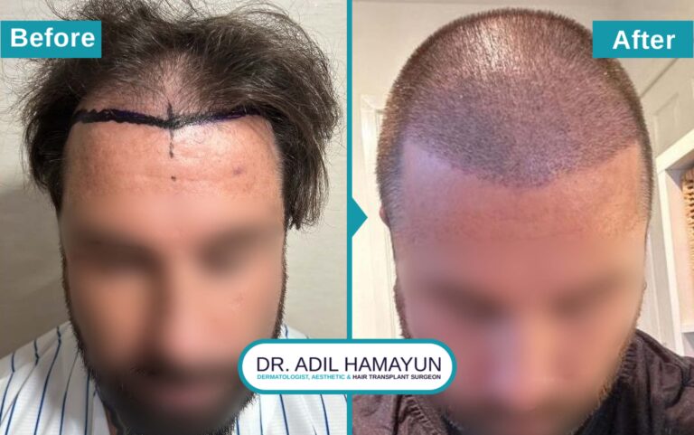 Best FUE Hair Transplant in Peshawar & Islamabad