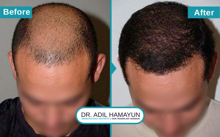 Hair Transplant