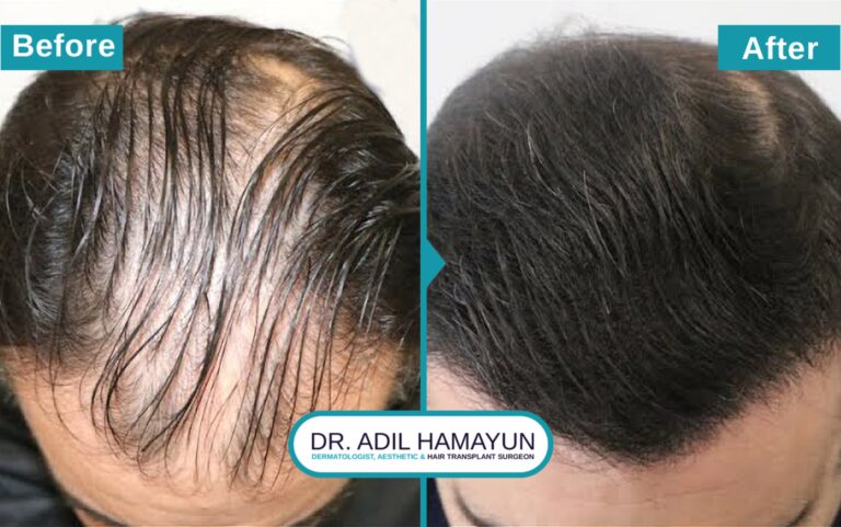 Hair Transplant