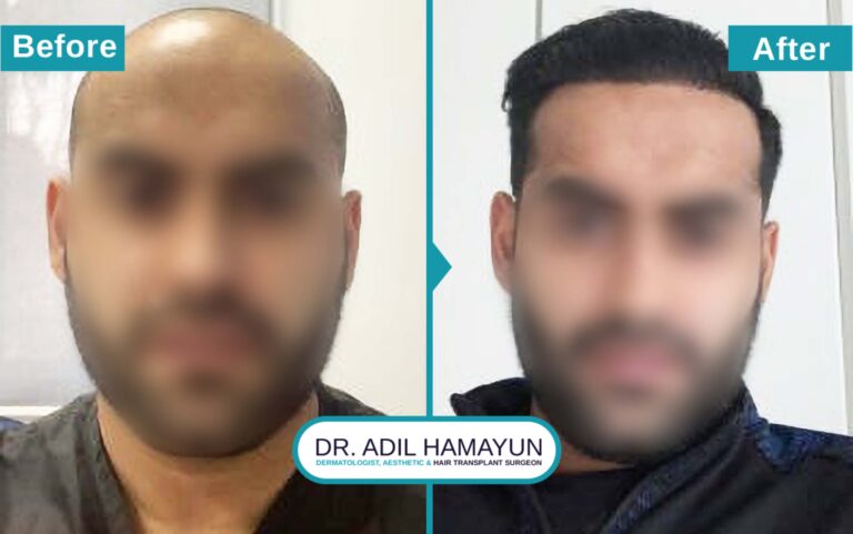 Hair Transplant