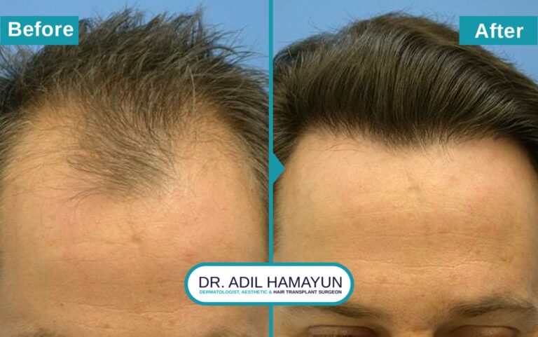 Hair Transplant