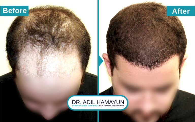 Best FUE Hair Transplant in Peshawar & Islamabad