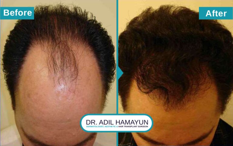 Best FUE Hair Transplant in Peshawar & Islamabad