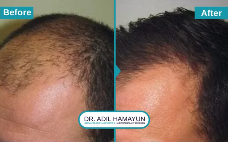 Best FUE Hair Transplant in Peshawar & Islamabad