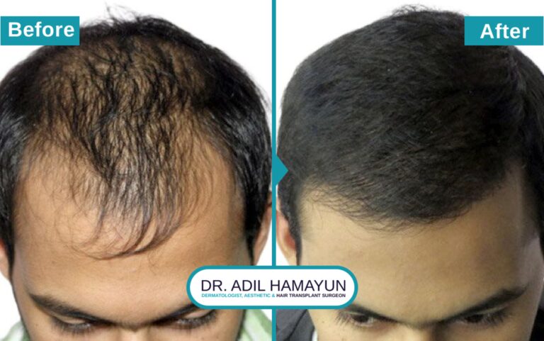 Best FUE Hair Transplant in Peshawar & Islamabad