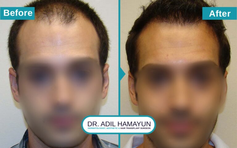 Hair Transplant