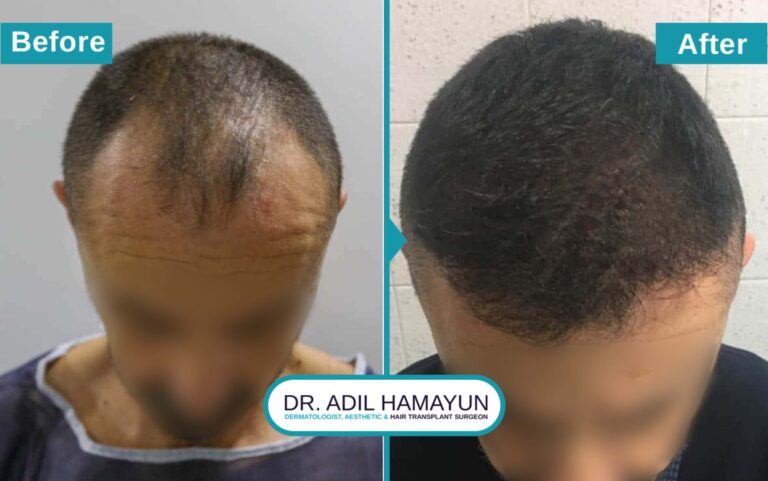 Hair Transplant