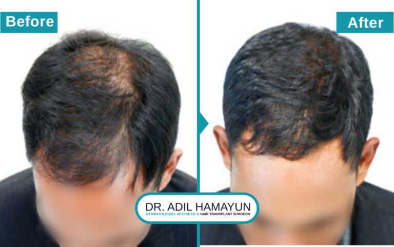 Hair Transplant