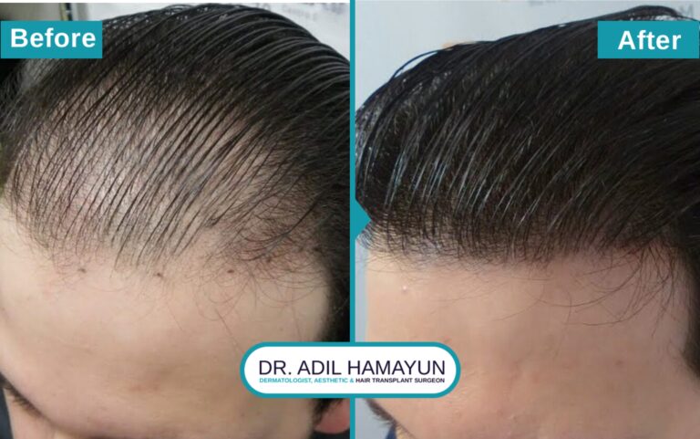 Best FUE Hair Transplant in Peshawar & Islamabad