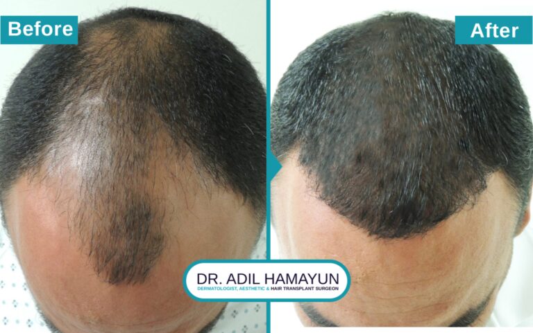 Best FUE Hair Transplant in Peshawar & Islamabad