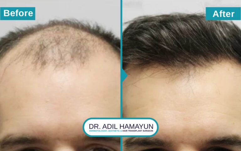 Best FUE Hair Transplant in Peshawar & Islamabad