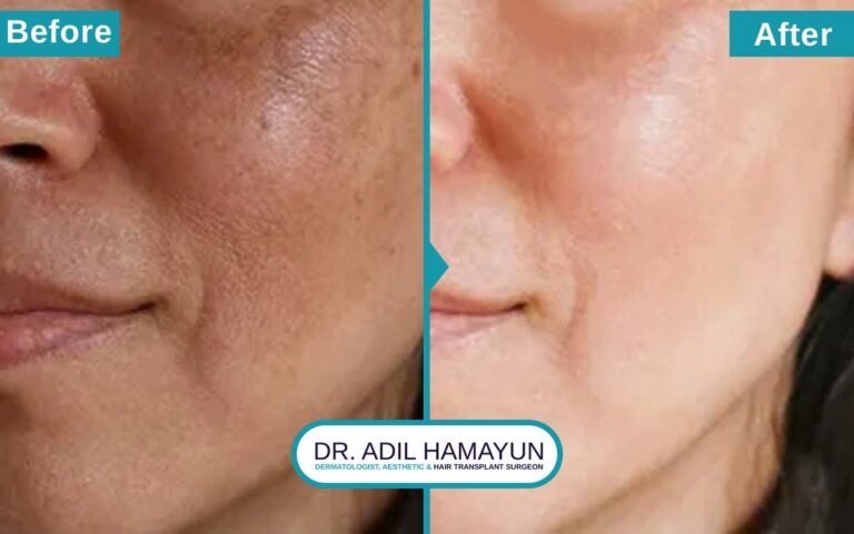 Melasma Removal Treatment