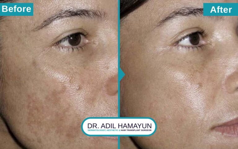 Melasma Removal Treatment