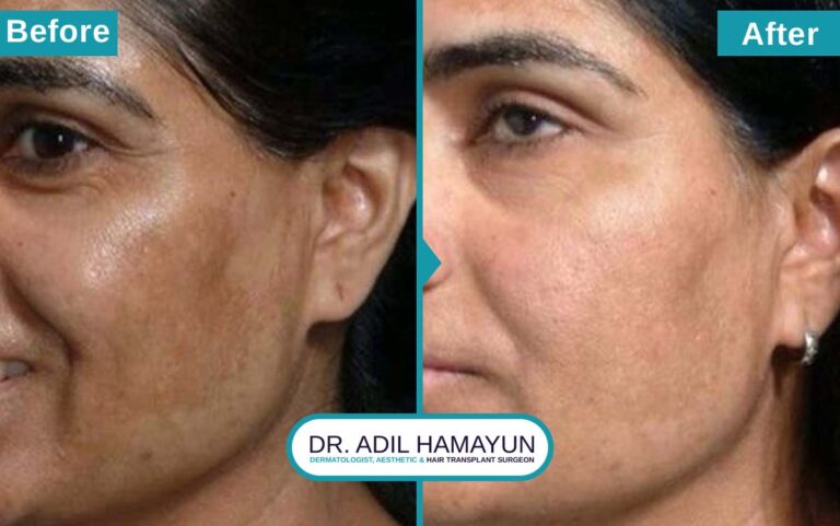 Melasma Removal Treatment