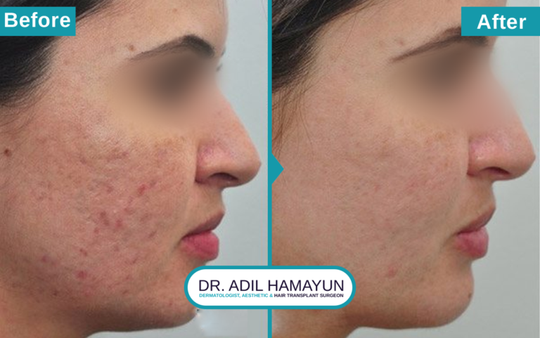 Best Doctor For Microneedling For Scars in Peshawar