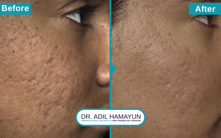 Best Doctor For Microneedling For Scars in Peshawar