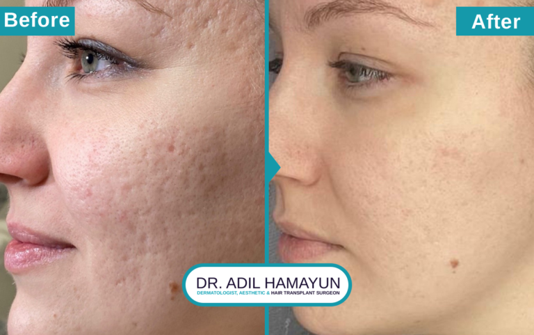 Best Doctor For Microneedling For Scars in Peshawar