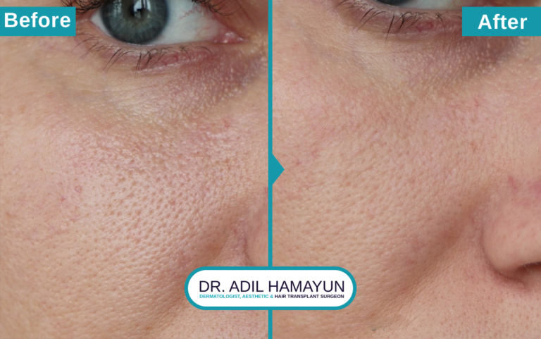 Best Doctor For Open Pores Treatment in Peshawar