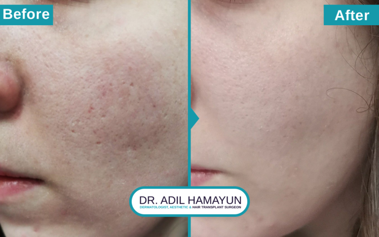 Best Doctor For Open Pores Treatment in Peshawar