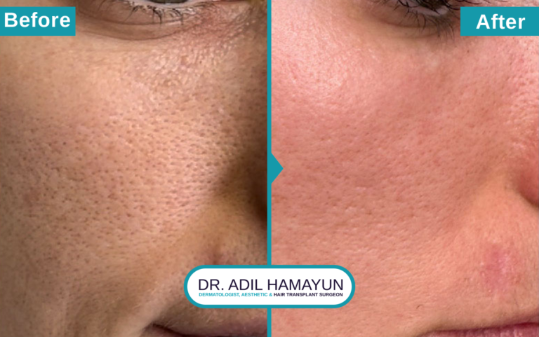 Best Doctor For Open Pores Treatment in Peshawar