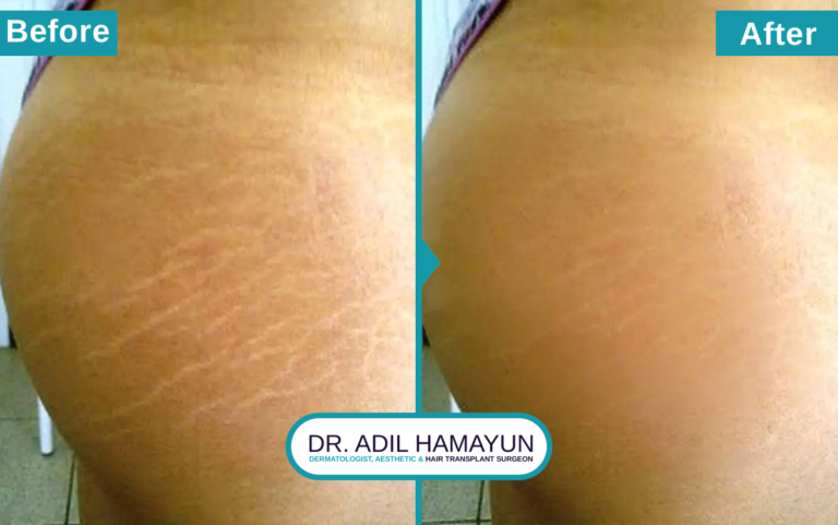 Best Doctor for Stretch Mark Removal Treatment in Peshawar