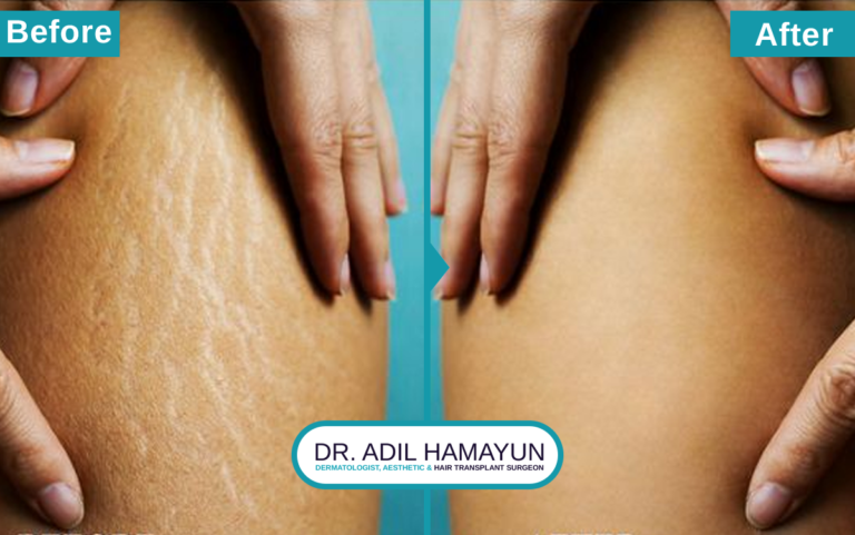 Best Doctor for Stretch Mark Removal Treatment in Peshawar