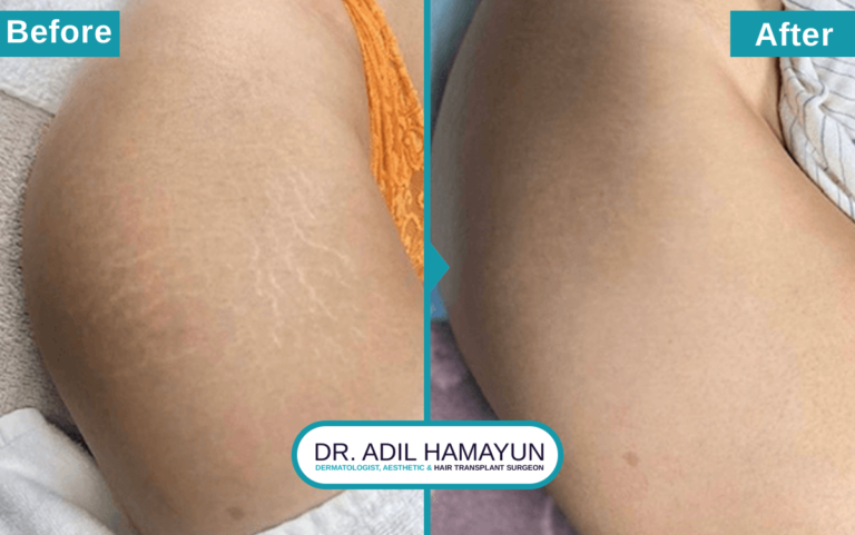 Best Doctor for Stretch Mark Removal Treatment in Peshawar