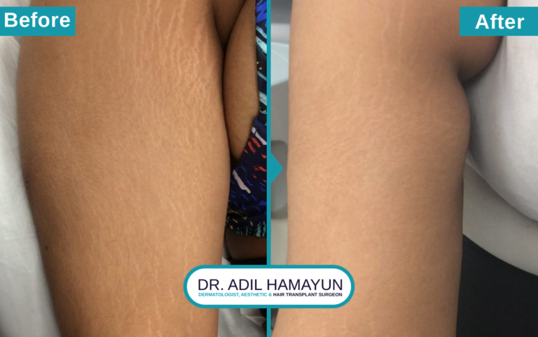 Best Doctor for Stretch Mark Removal Treatment in Peshawar