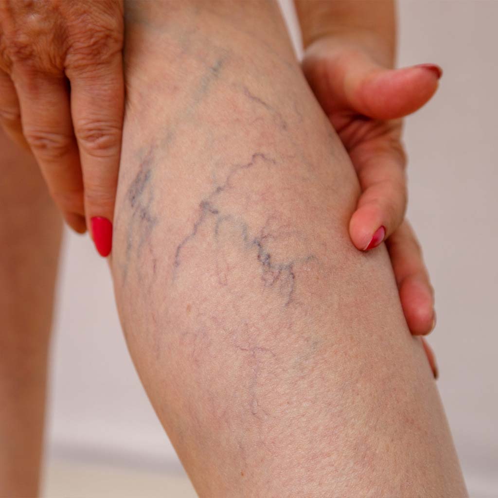 Varicose veins